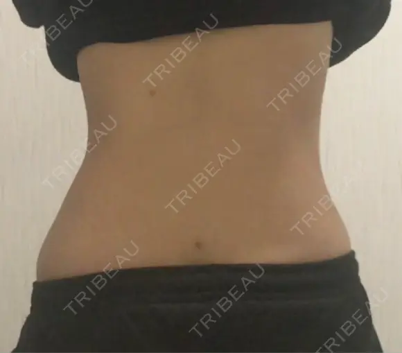 脂肪吸引（お腹） ドクターフィット（Dr.fit）クリニック DAY 42 メイン用