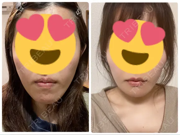骨切り（あご） ヤスミクリニック DAY 95 メイン用