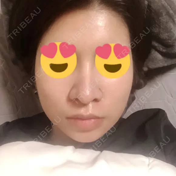 隆鼻術 / 鼻尖形成（切開） / 鼻中隔延長（切開） / 骨切幅寄せ 表参道スキンクリニック 表参道院 AFTER メイン用