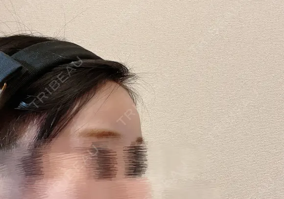 ヒアルロン酸注入（額） MSC LUNA CLINIC 渋谷院 DAY 0 メイン用