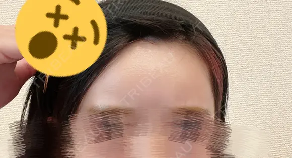 ヒアルロン酸注入（額） MSC LUNA CLINIC 渋谷院 DAY 0 メイン用