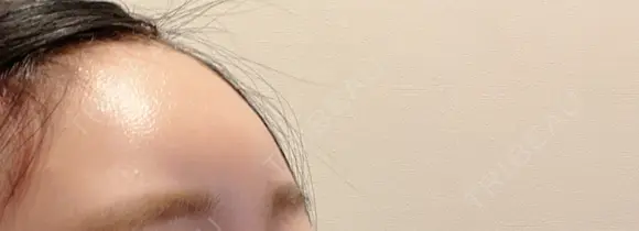 ヒアルロン酸注入（額） MSC LUNA CLINIC 渋谷院 DAY 1 メイン用