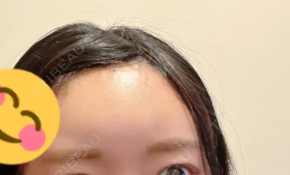 ヒアルロン酸注入（額） MSC LUNA CLINIC 渋谷院 DAY 1 メイン用