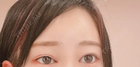 ヒアルロン酸注入（額） MSC LUNA CLINIC 渋谷院 DAY 2 メイン用