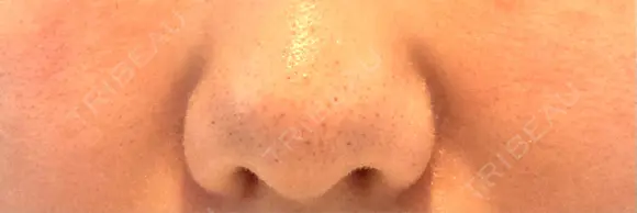 鼻翼基部形成（貴族手術） ノーチェビューティクリニック AFTER メイン用