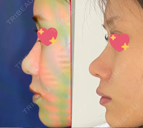 軟骨移植 R.O.clinic DAY 80 メイン用