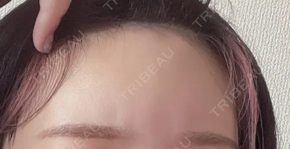 ヒアルロン酸注入（額） MSC LUNA CLINIC 渋谷院 AFTER メイン用