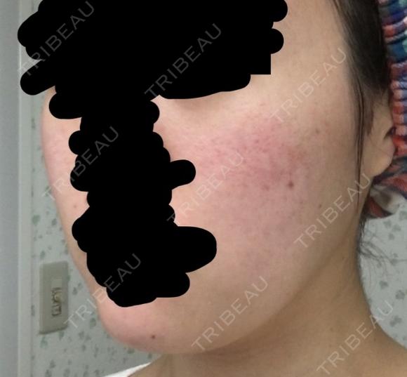 その他（肌） / 再生医療 / PRP皮膚再生療法 聖心美容クリニック 六本木院 DAY 7 メイン用