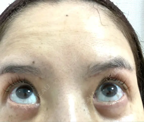 糸リフト / クマ治療 / 下まぶたたるみ取り / 下まぶたの脂肪取り / 眉下切開 / 脂肪注入（額） 銀座みゆき通り美容外科 東京本院 DAY 93 メイン用