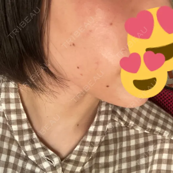 ピコレーザートーニング（美白・肝斑） / ピコフラクショナルレーザー（毛穴・ニキビ跡） いしかわ皮ふ科・形成外科 豊後大野院 DAY 10 メイン用
