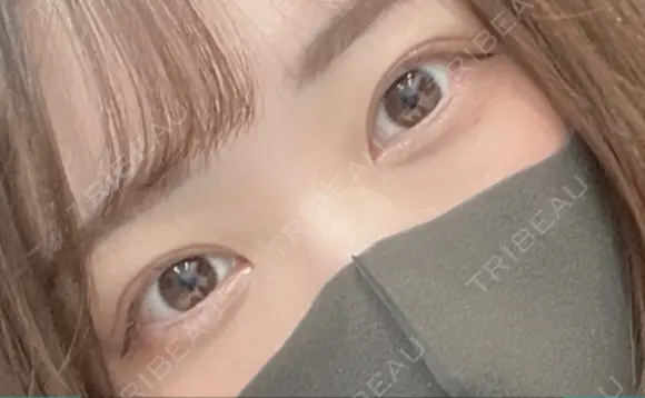二重埋没 アリエル美容クリニック 大宮院 DAY 39 メイン用