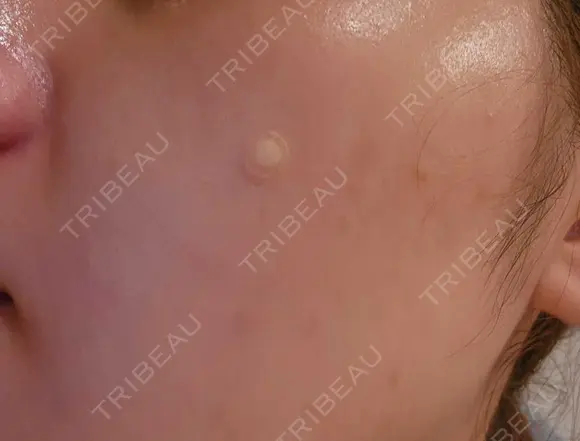 ピコレーザートーニング（美白・肝斑） / フラクショナルレーザー（毛穴・ニキビ跡） ルラ美容クリニック 渋谷本院 DAY 20 メイン用