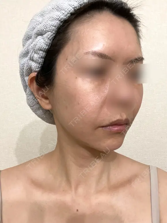 脂肪吸引（顔） / 切開リフト / 脂肪注入（輪郭） 牧野美容クリニック DAY 528 メイン用