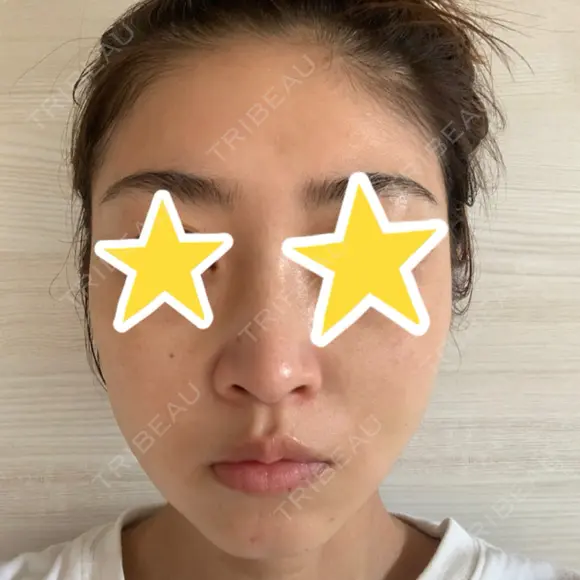 糸リフト 湘南美容クリニック 宇都宮院 DAY 9 メイン用