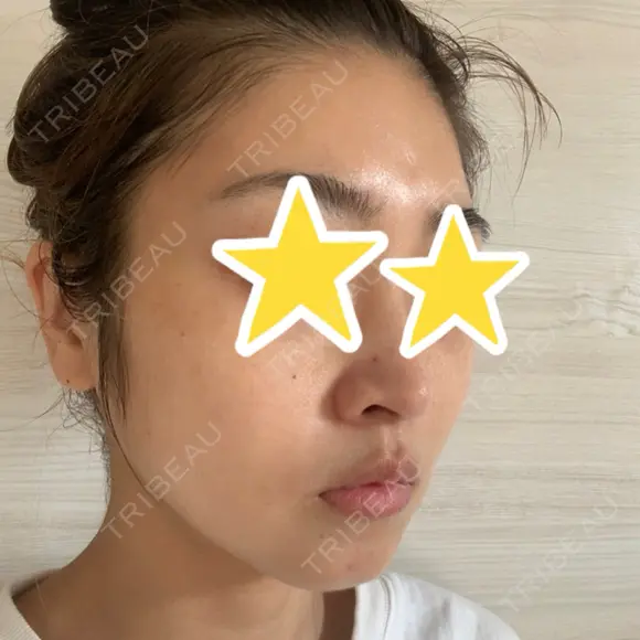 糸リフト 湘南美容クリニック 宇都宮院 DAY 9 メイン用