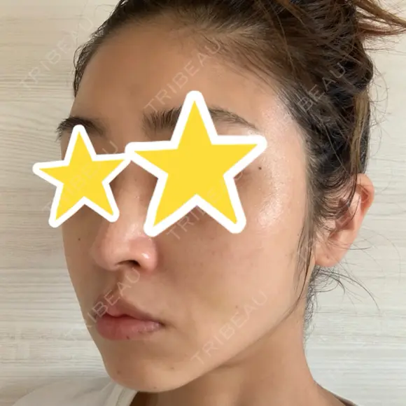 糸リフト 湘南美容クリニック 宇都宮院 DAY 9 メイン用