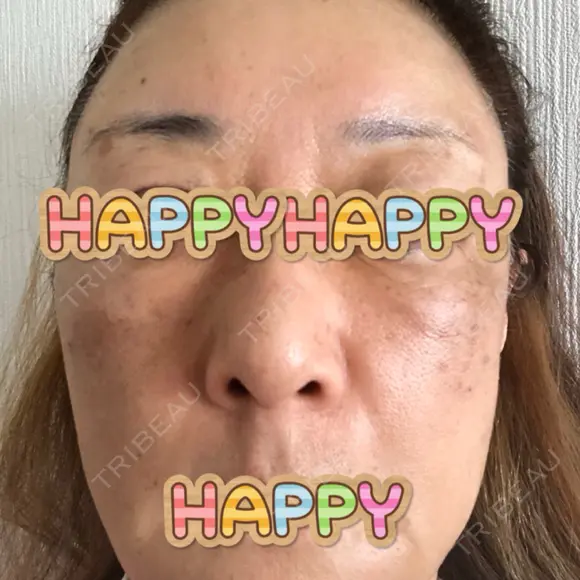 脂肪吸引（顔） / 脂肪注入（額） / 切開リフト 札幌ル・トロワ ビューティクリニックVogue DAY 217 メイン用