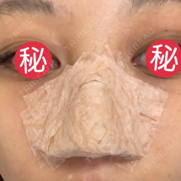 軟骨移植 フェアクリニック川口 DAY 0 メイン用