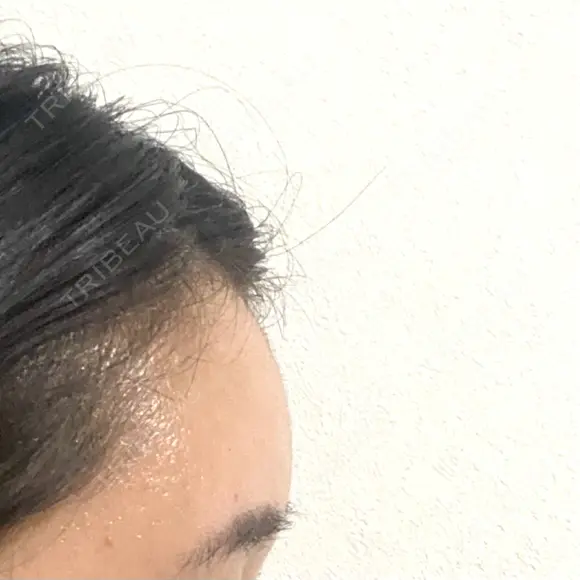 額を丸く / こめかみ形成 / 脂肪注入（額） あつぎ美容クリニック DAY 40 メイン用