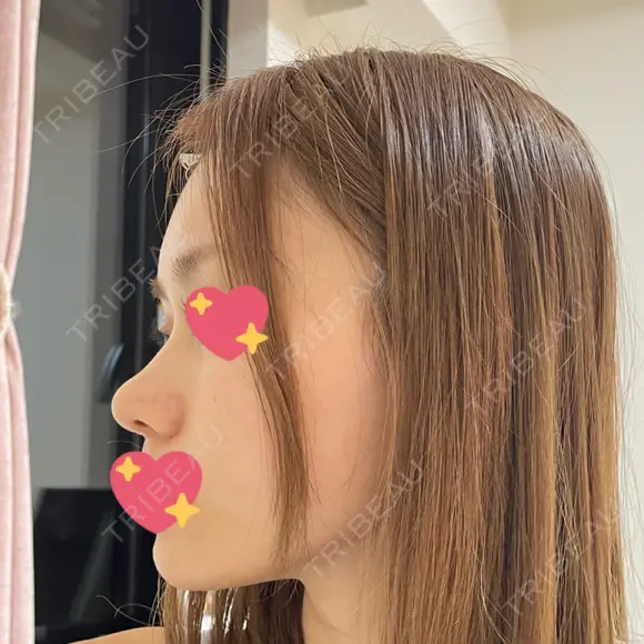 軟骨移植 R.O.clinic DAY 94 メイン用