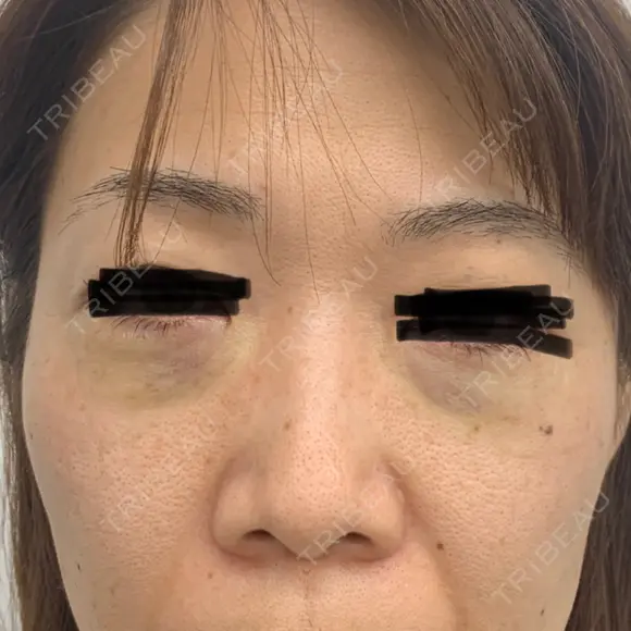 下まぶたの脂肪取り 東郷美容形成外科　福岡 DAY 0 メイン用