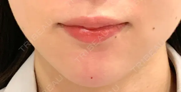 ヒアルロン酸注入（あご） id美容クリニック 銀座院 AFTER メイン用