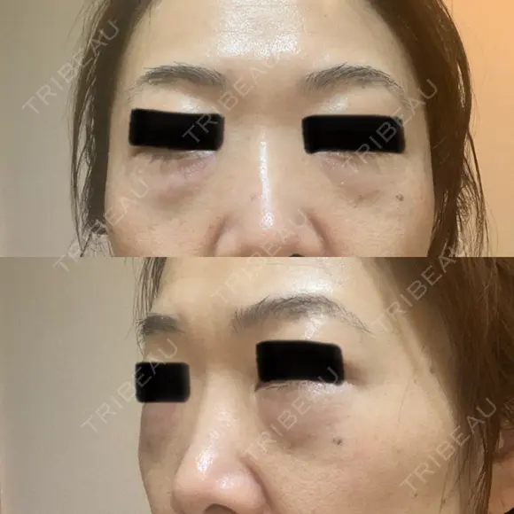 下まぶたの脂肪取り 東郷美容形成外科　福岡 DAY 1 メイン用