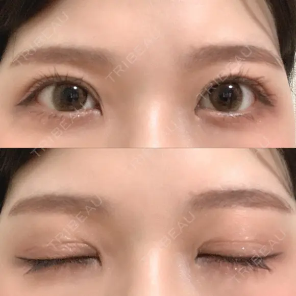 二重切開 / その他（目元） LIKI CLINIC KOBE AFTER メイン用