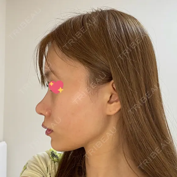 軟骨移植 R.O.clinic DAY 97 メイン用