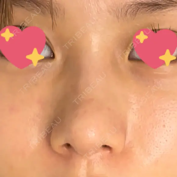 軟骨移植 R.O.clinic DAY 97 メイン用