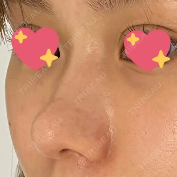 軟骨移植 R.O.clinic DAY 97 メイン用