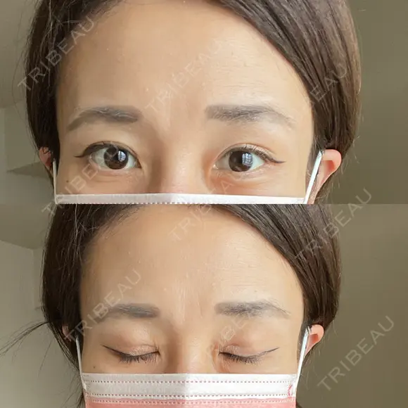二重切開 / 眼瞼下垂（切開） 湘南美容クリニック Regno 銀座院 AFTER メイン用