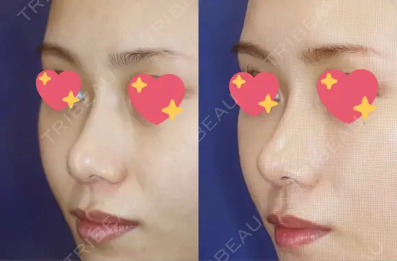 軟骨移植 R.O.clinic DAY 98 メイン用