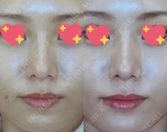 軟骨移植 R.O.clinic DAY 98 メイン用