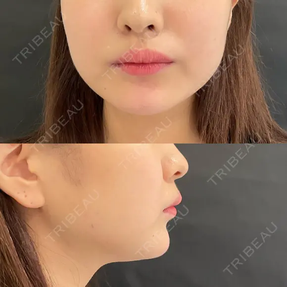 ヒアルロン酸注入（あご） / ボトックス（エラ・小顔） / ボトックス（口角） id美容クリニック 銀座院 AFTER メイン用