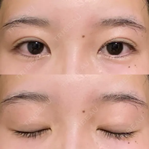 二重埋没 / 自然癒着法 シンデレラ＆ダヴィンチクリニック DAY 424 メイン用