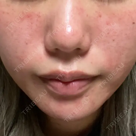 ヴェルヴェットスキン ルラ美容クリニック 大宮院 / ルラスキンクリニック 大宮院 DAY 0 メイン用