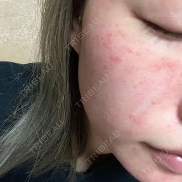 ヴェルヴェットスキン ルラ美容クリニック 大宮院 / ルラスキンクリニック 大宮院 DAY 1 メイン用