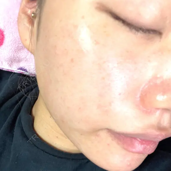 ヴェルヴェットスキン ルラ美容クリニック 大宮院 / ルラスキンクリニック 大宮院 AFTER メイン用