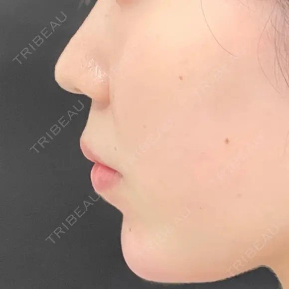 レディエッセ注入（あご） id美容クリニック 銀座院 AFTER メイン用