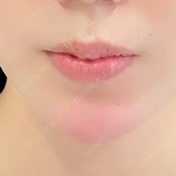 レディエッセ注入（あご） id美容クリニック 銀座院 DAY 0 メイン用