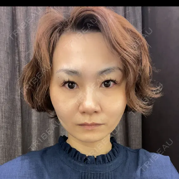 糸リフト 心斎橋形成外科スキンケアクリニック DAY 0 メイン用