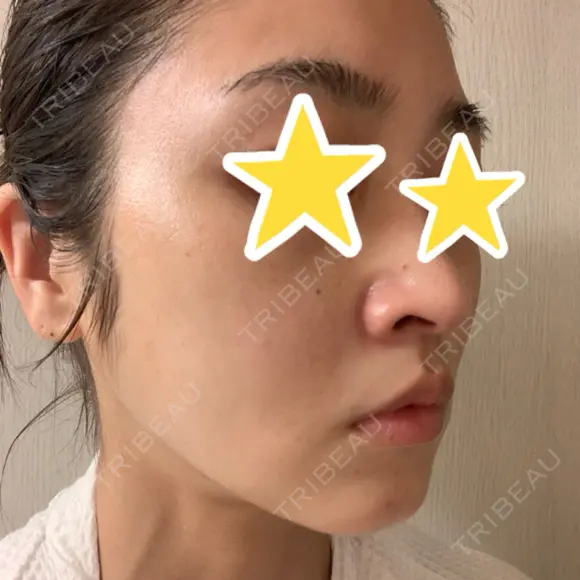 糸リフト 湘南美容クリニック 宇都宮院 DAY 32 メイン用