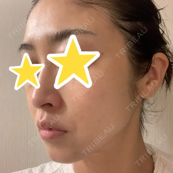 糸リフト 湘南美容クリニック 宇都宮院 DAY 32 メイン用