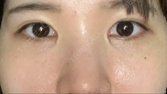 目頭切開 eクリニック 金沢本院 DAY 14 メイン用