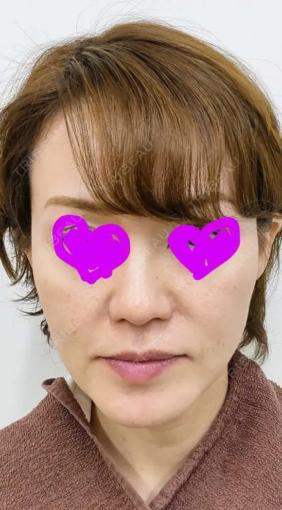 肌ヒアルロン酸注入（たるみ・シワ改善） 渋谷美容外科クリニック 渋谷院 DAY 0 メイン用