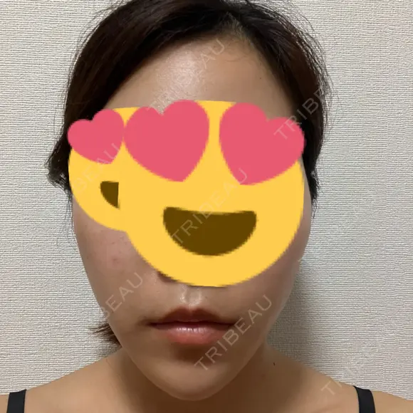 糸リフト / ヒアルロン酸注入（あご） 大阪消化器内科・内視鏡クリニック難波院 DAY 1 メイン用