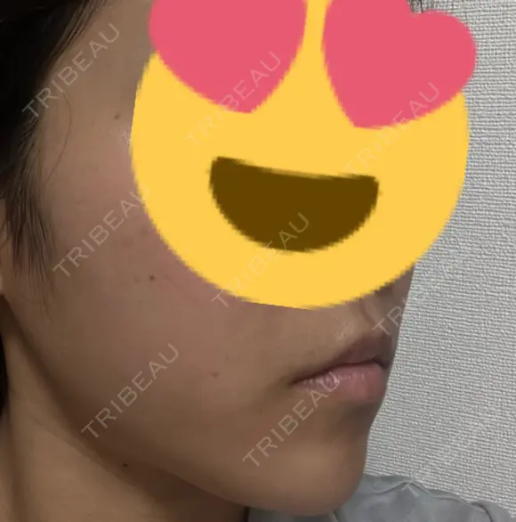 糸リフト / ヒアルロン酸注入（あご） 大阪消化器内科・内視鏡クリニック難波院 DAY 7 メイン用