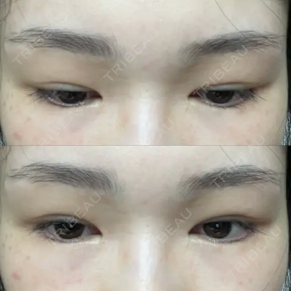 二重切開 / 目頭切開 / 眼瞼下垂（切開） / 上まぶたの脂肪取り 銀座マイアミ美容外科 DAY 506 メイン用