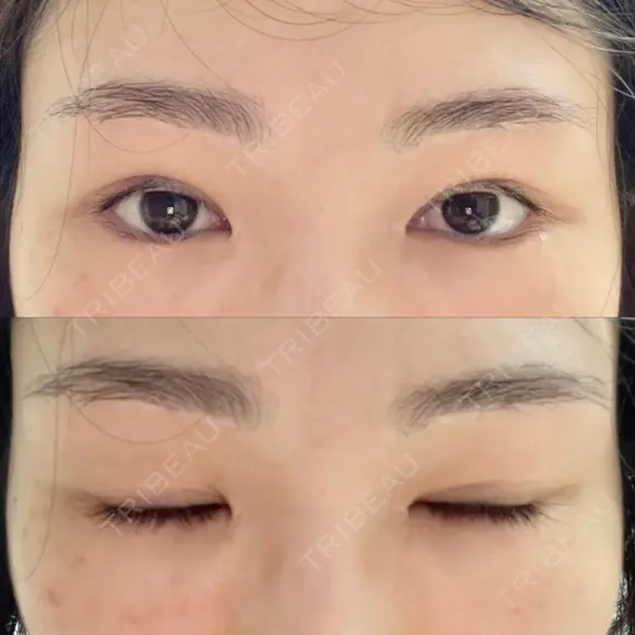 二重切開 / 目頭切開 / 眼瞼下垂（切開） / 上まぶたの脂肪取り 銀座マイアミ美容外科 AFTER メイン用